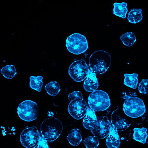 Blue leukemia cells against a black background.